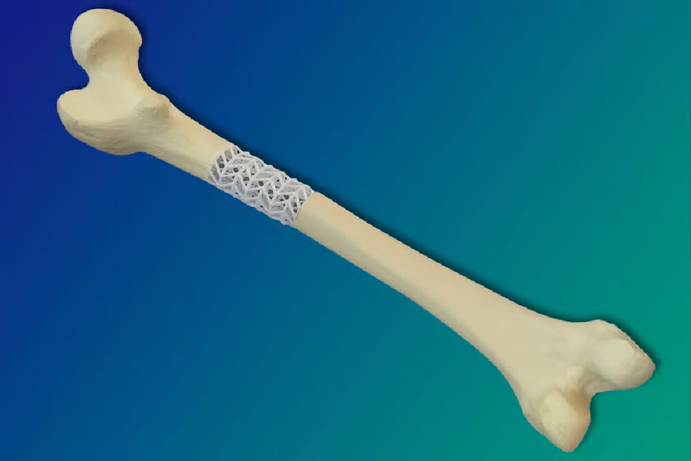 ابداع کامپوزیت جدیدی که می‌تواند استخوان‌های شکسته را ترمیم کند